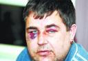 BEATEN UP: Andrew Nixon suffered head injuries and broken fingers when yobs attacked him while he was out in his car