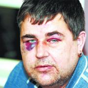 BEATEN UP: Andrew Nixon suffered head injuries and broken fingers when yobs attacked him while he was out in his car