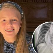 Teegan Chilton, 15, has had an operation to repair the curvature of her spine