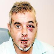 THINK FIRST: Timothy Eastham in the aftermath of the attack which saw him floored by a single punch. He is still facing treatment for the injuries shown, which included a broken jaw and eye socket