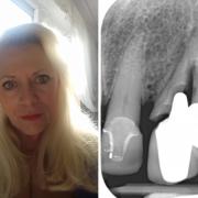 Susan Alty and her failed root canal and post crown