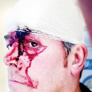 Mark Schofield after the attack
