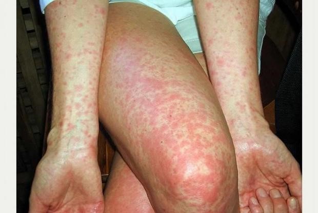 Parents alerted after scarlet fever cases increase in North West