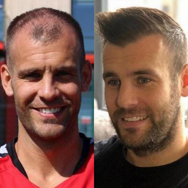 Lancashire Telegraph : Tommy Spurr avant et après une greffe de cheveux