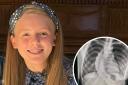 Teegan Chilton, 15, has had an operation to repair the curvature of her spine