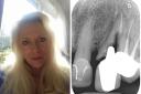 Susan Alty and her failed root canal and post crown