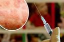 Measles may be on the rise after 10 new potential cases reported in Lancashire
