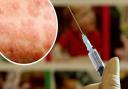Measles is on the rise with 10 new cases confirmed in Lancashire