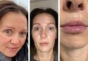 Mum-of-three with cleft-palate says lip fillers gave her newfound confidence