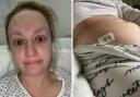 Jodie Hamer. Right is Jodie after having laparoscopy surgery for endometriosis