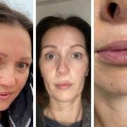 Mum-of-three with cleft-palate says lip fillers gave her newfound confidence