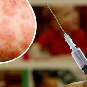 Measles is on the rise with 10 new cases confirmed in Lancashire