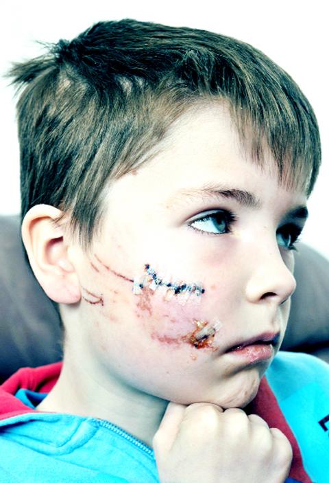 Owen Poole with bite marks on his face